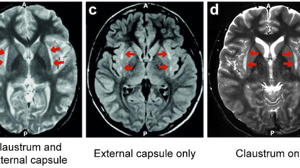 Series of six brain scan images showing: a health human brain; claustrum and external capsule; external capsule only; and claustrum only.